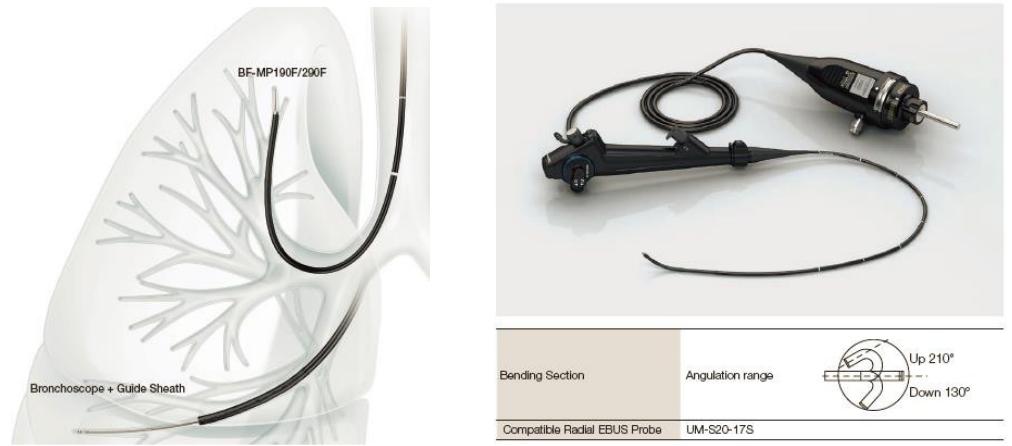 支气管镜高频电刀治疗中央型肺癌,支气管镜在早期肺癌诊断的意义