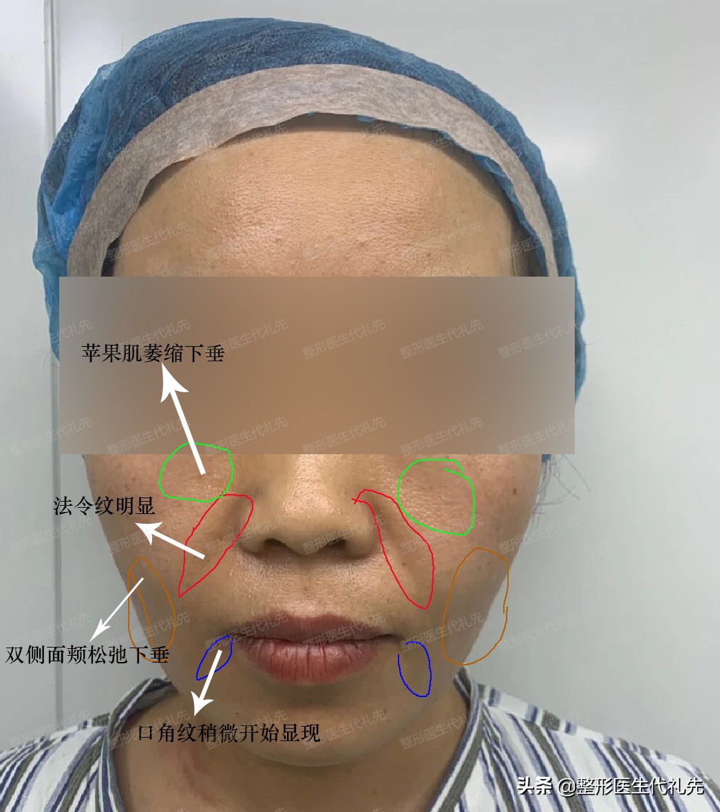 法令纹怎么改善三个方法学起来,有没有特别好的淡化法令纹的方法