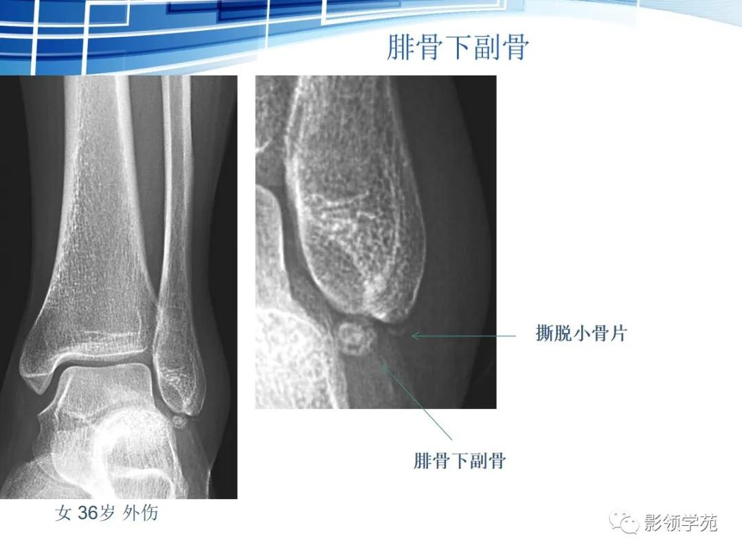 桡骨远端骨折引起尺骨变异,撕脱骨折一个月无明显骨痂形成
