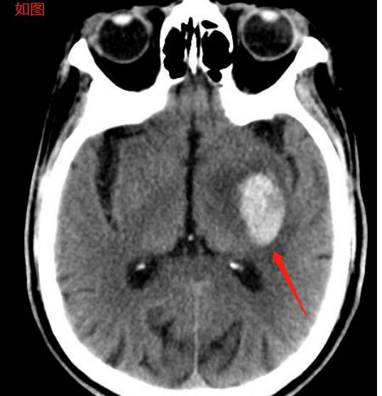 脑出血病因完整版,53个经典病例分析脑出血
