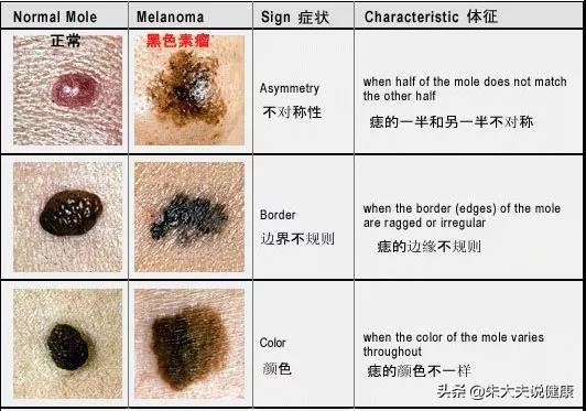 人平均会有几颗痣,从小有颗痣一般有问题吗