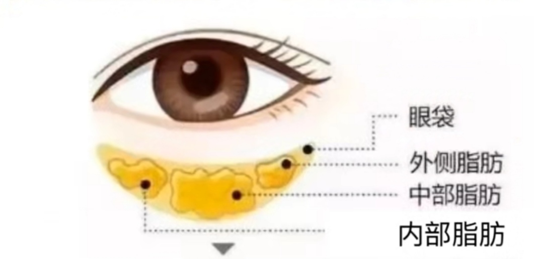 眼袋我该拿你怎么办？“真假性”眼袋你知道吗？