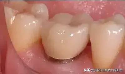 牙齿以前齐现在不齐是什么原因,牙齿排列整齐牙缝大前门牙凸