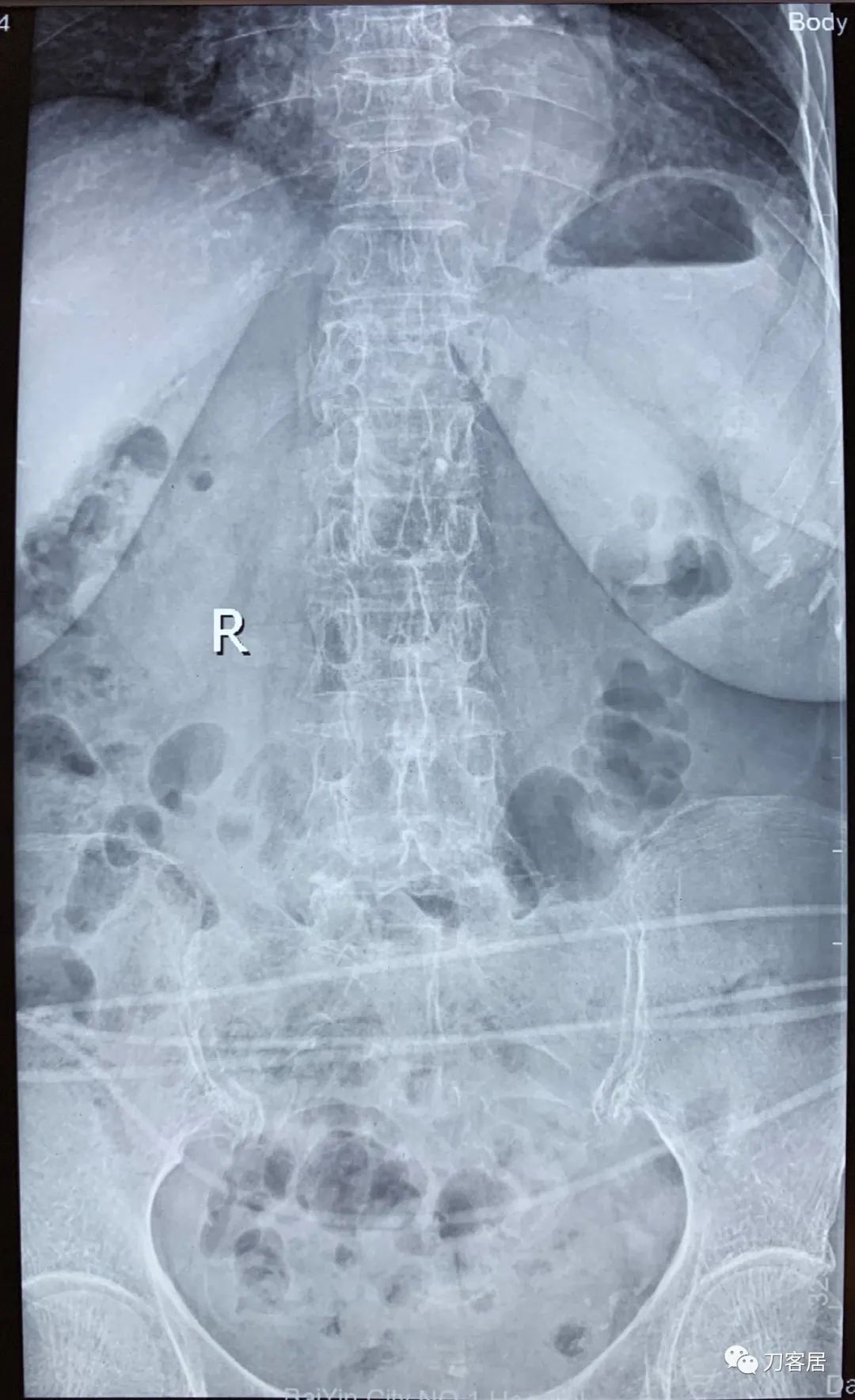 胸椎压缩性骨折病历,脊柱骨质疏松性压缩性骨折