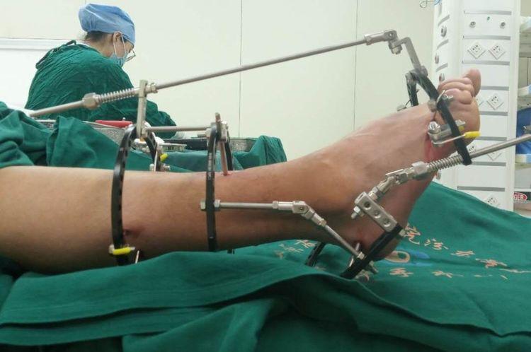 太原中心医院骨科汾东一病区完成首例ilizarov外固定矫形高弓足