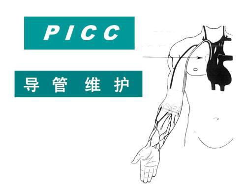 picc置管后患者可以做什么运动,中心静脉置管和picc置管的区别
