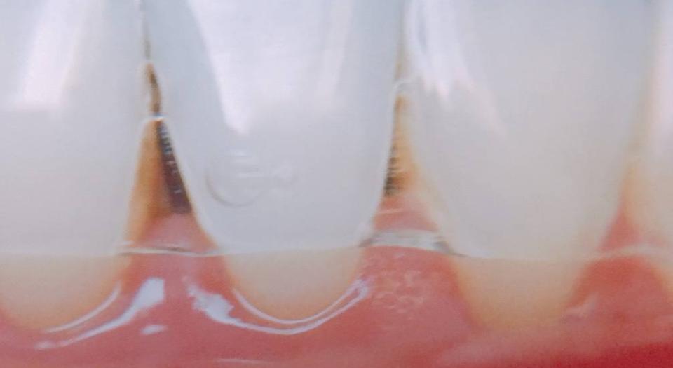 牙齿严重黑三角怎么补救,牙齿出现黑三角能矫正吗