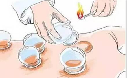 中医拔火罐治疱疹视频,中医拔火罐操作视频