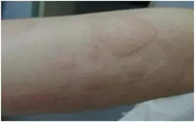 怎么区别麻疹和风疹,麻疹识别图