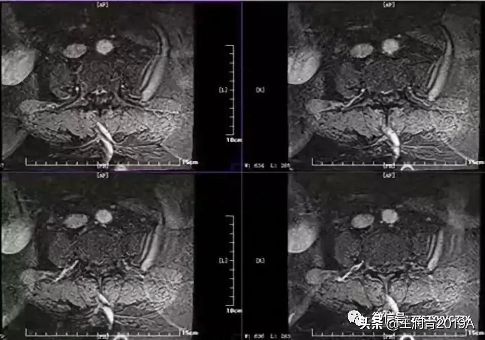 弯腰捡东西，腰痛腿麻大小便*禁失**，竞是腰椎间盘髓核脱出惹的祸