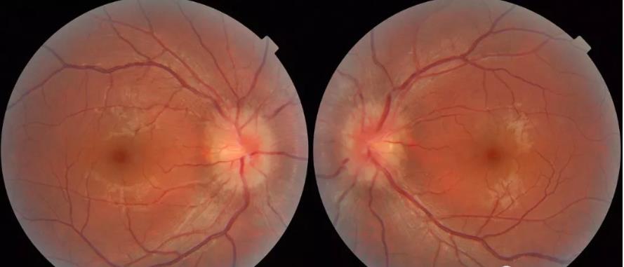 颅高压第一篇：视乳头水肿