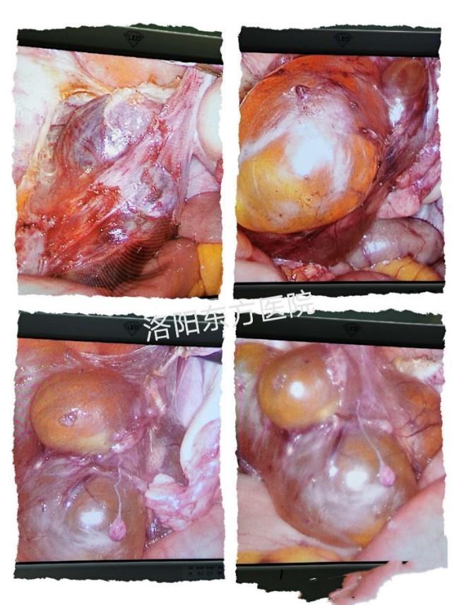 盆腔囊肿要复查吗,盆腔囊性占位灶建议复查