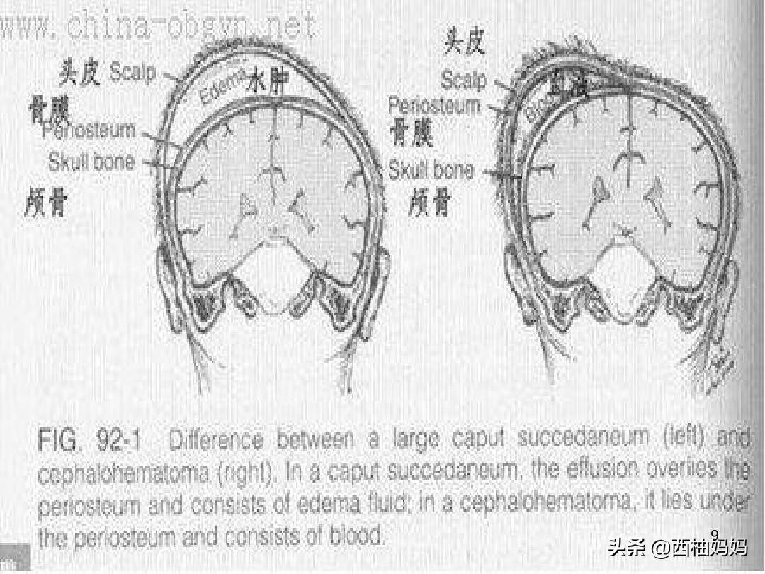 辟谣:“产瘤”十一天还没有消失,变硬就来不及了?要去抽出来?