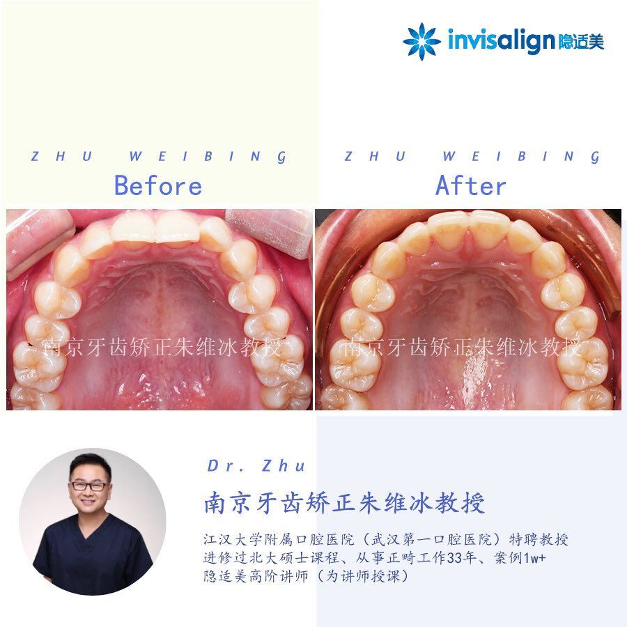 南京口腔医院矫正一颗牙齿多少钱,大医院为啥不建议做牙齿矫正