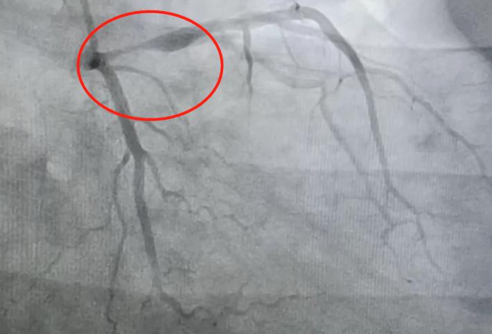 胸痛排除肺和心脏还能是什么病,胸痛排除心脏病