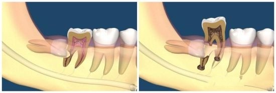智齿拔下牙不拔上牙有什么影响吗,智齿拔了不拔有什么影响