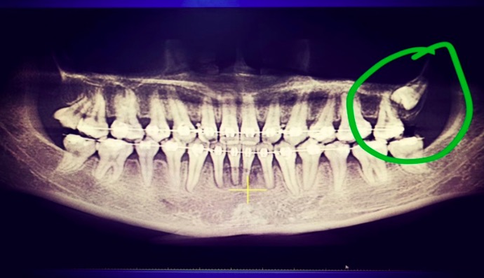 智齿向脸颊方向长一定要拔吗,40岁智齿横着长一定要拔吗