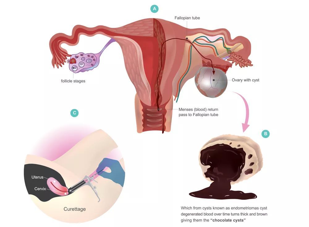 卵巢巧克力囊肿并且有点肠子粘连,卵巢巧克力囊肿穿刺会影响卵巢吗
