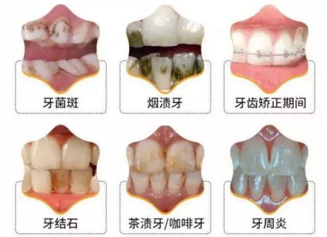 洁牙后，牙齿出现黑斑，是蛀牙了吗？再也不去洁牙了