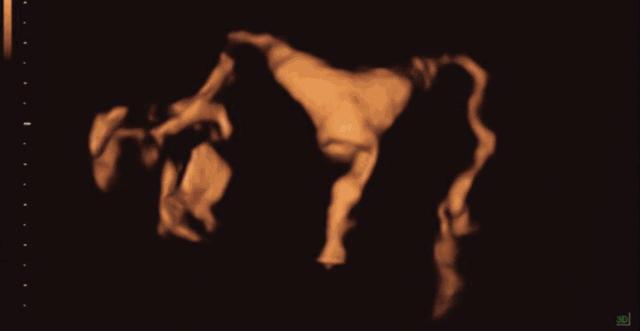 4步讲解输卵管造影检查过程