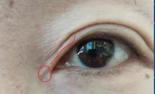 女子双眼皮整容失败,女子整容后惨不忍睹