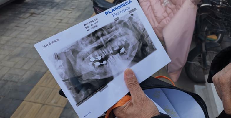 洛阳老人补牙,七旬阿姨多颗牙缺失修复前后