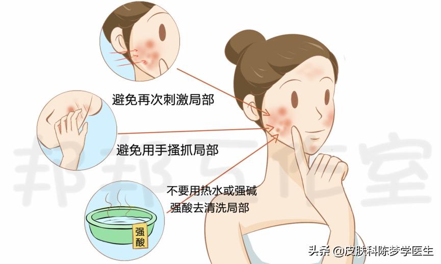 网上卖的治疗湿疹中药膏含激素吗,治疗湿疹的激素药膏药店可以买