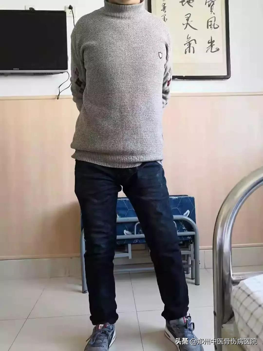 长短腿步态和跳跃性步态,大腿往内旋转纠正步态