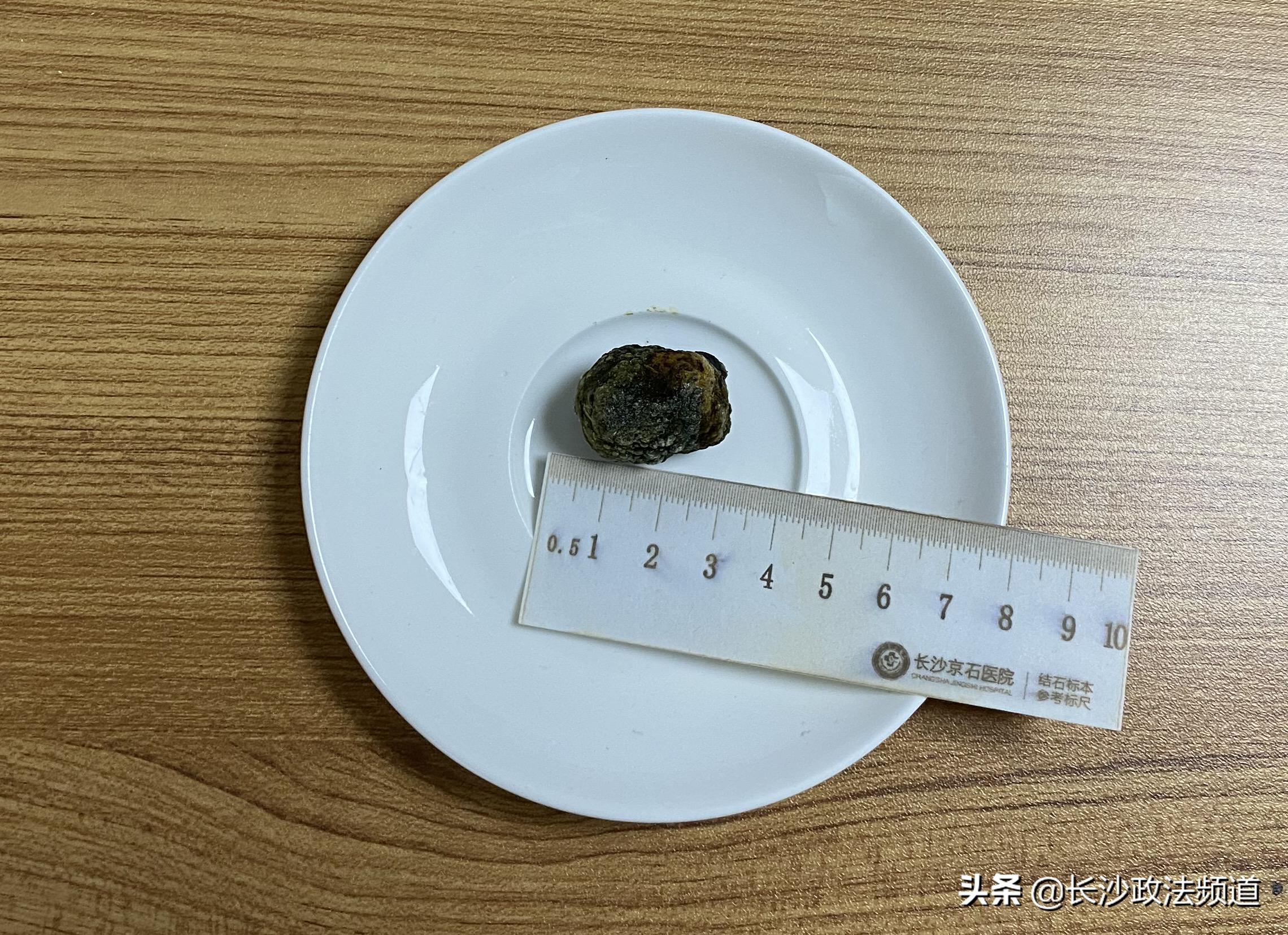 女子胸口疼去医院,女子胸口胀痛