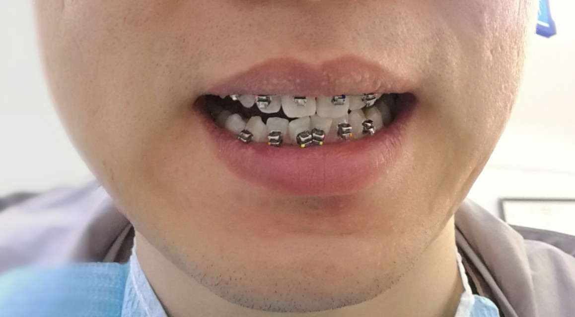 小伙相亲被弃，“大凸牙，我不要嫁给你”快三十，矫正还来得及？