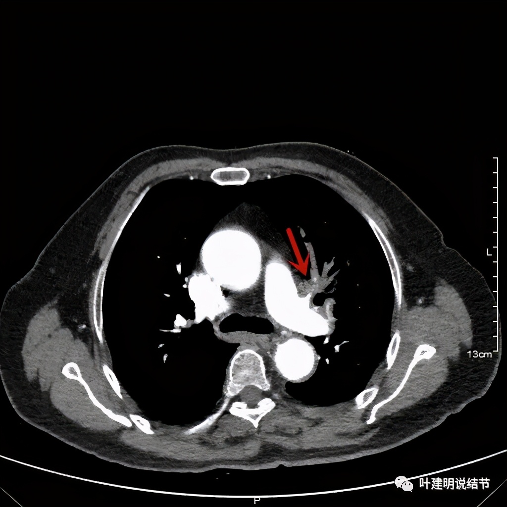 卡瑞利珠单抗治疗肺鳞癌有用吗,特瑞普利单抗对鳞癌治疗有效吗