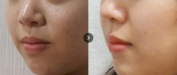 水光针真的比面膜好吗,1次水光等于1000张面膜