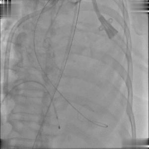 BAV遭遇心脏突然停跳，Sapien3快速植入挽救患者生命