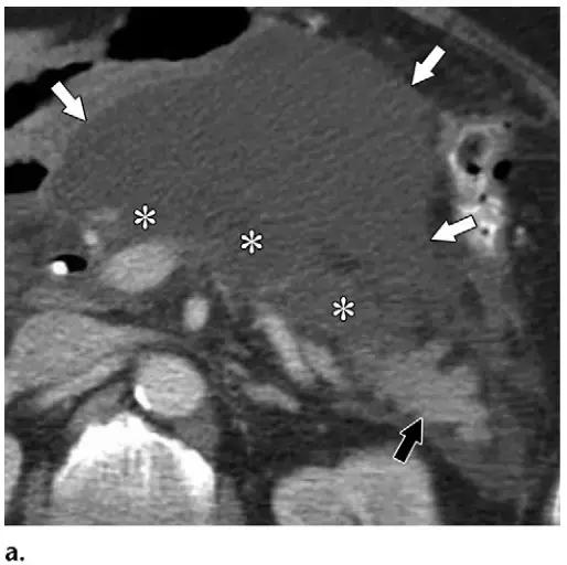 急性胰腺炎影像检查首选,急性坏死胰腺炎影像