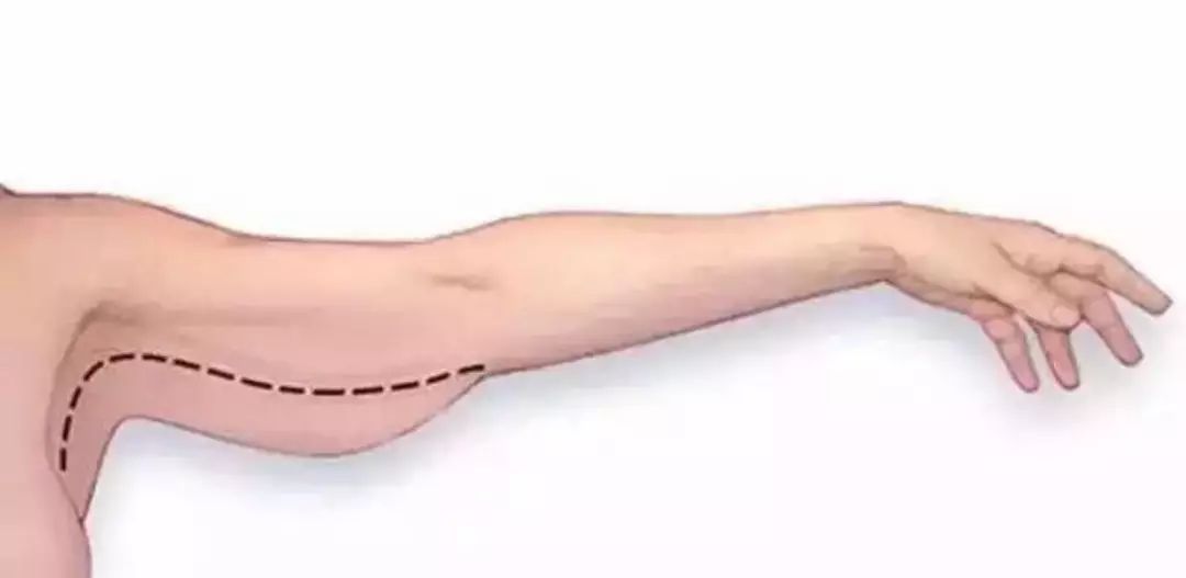 上半身胖肩宽胳膊粗,上半身肩宽显壮怎么办