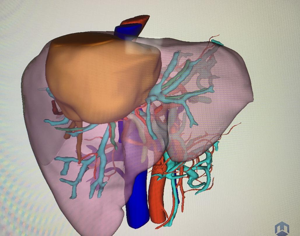 外科手术珠穆朗玛峰,肝胆外科的珠穆朗玛峰