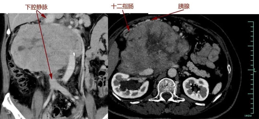 胃口差新冠,胃口变好新冠