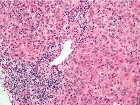 系统性红斑狼疮肠道病变,系统性红斑狼疮消化系统症状