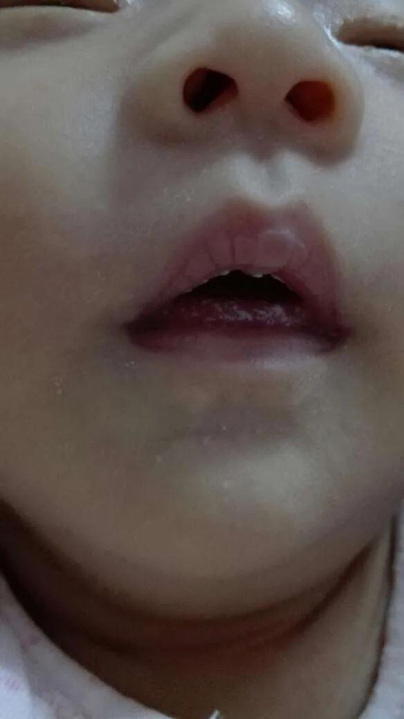 奶垢?鹅口疮?家长要分得清,才能及时治疗!