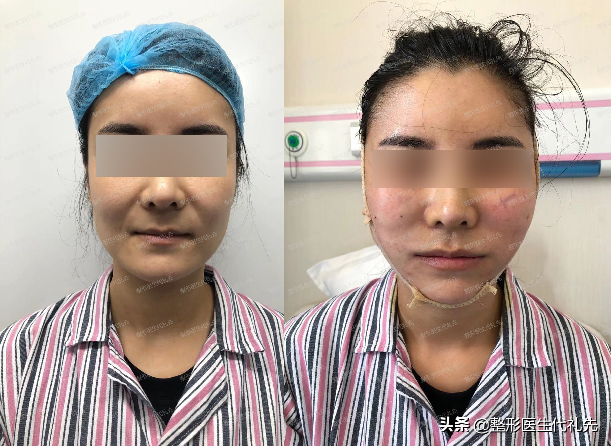 大拉皮和面部微创提升术的区别,小切口面部提升是小拉皮手术吗