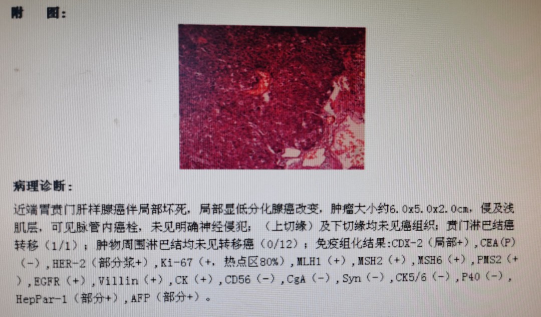 贲门癌吐血抢救,中国最著名的贲门癌治疗专家