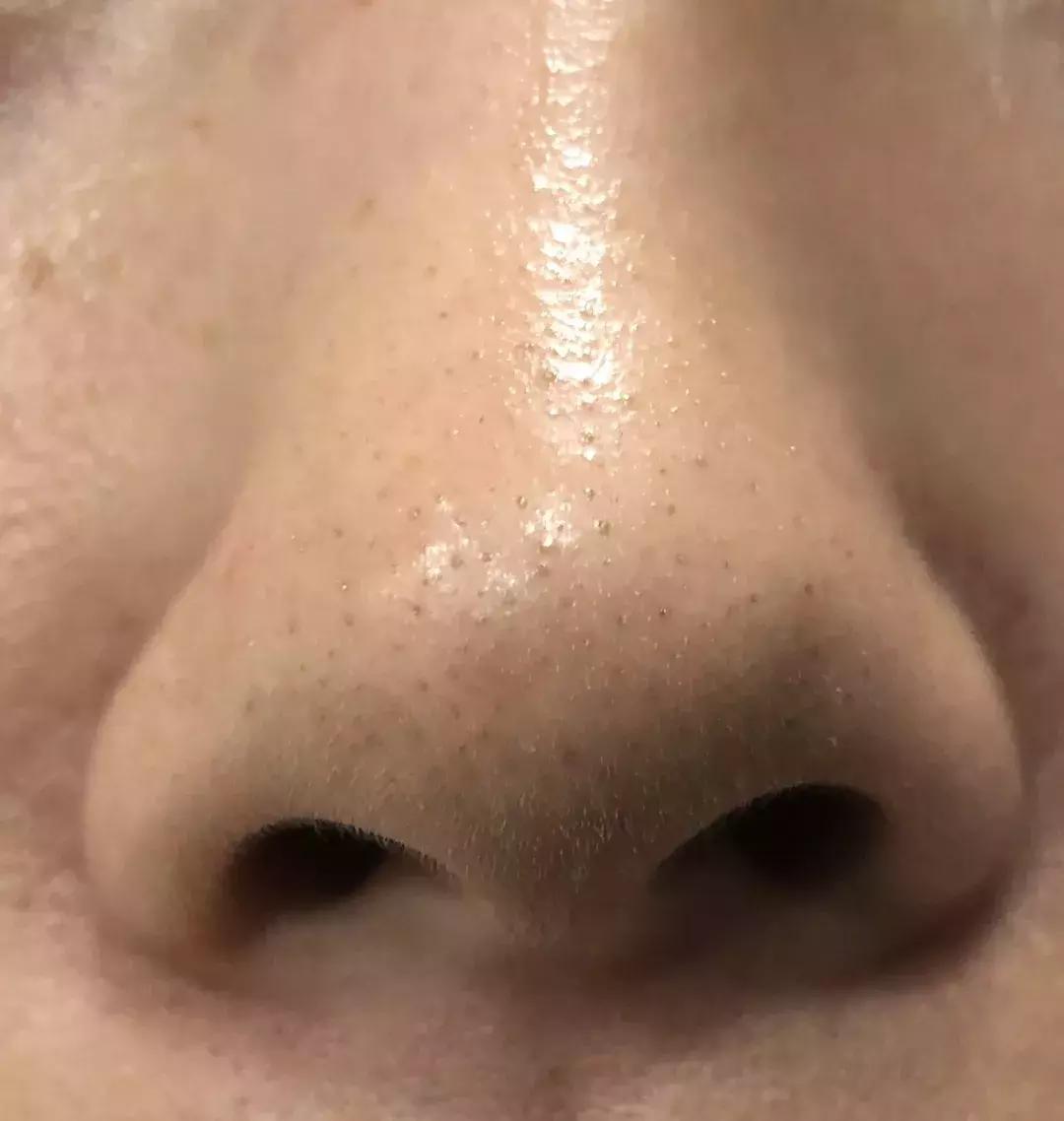 吸黑头神器去粉刺角质收缩毛孔,皮肤清洁收缩毛孔黑头角质