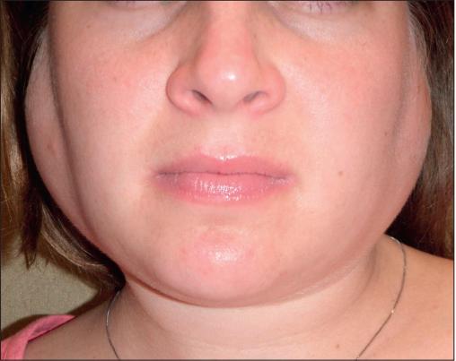 干燥综合症最怕的三种食物,干燥综合症的8大临床特征