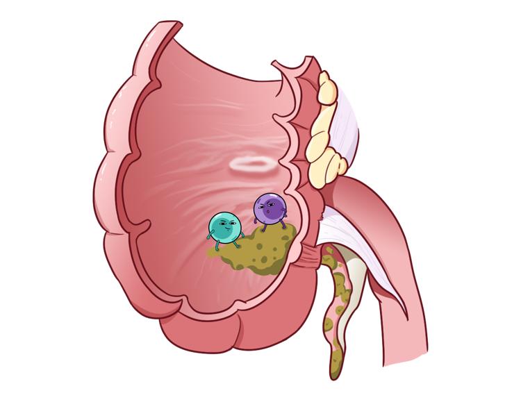 急性阑尾炎疼到什么程度,急性阑尾炎为什么那么急