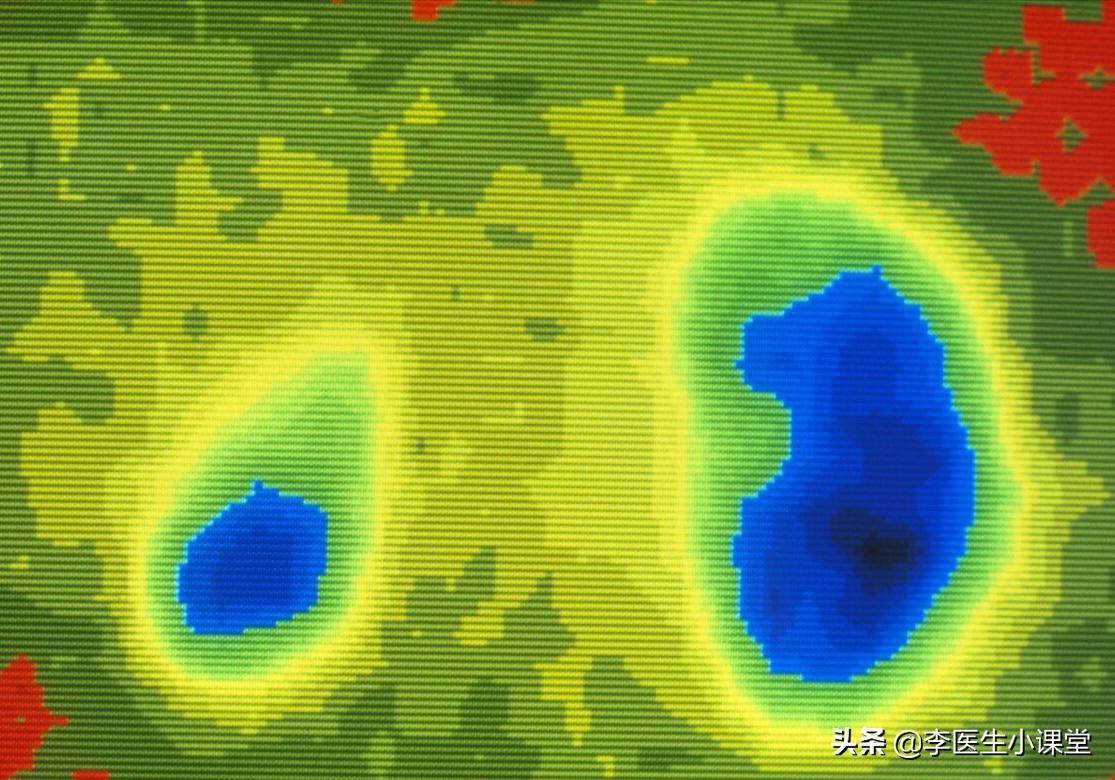 肾不好要怎么办？坚持做好这3点，有助于预防肾衰竭