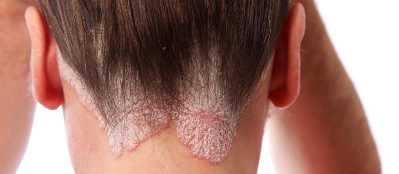 头皮起红疙瘩还有头屑怎么回事,男生头屑多头皮有红疙瘩