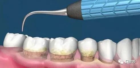 牙齿清洁的最佳方法,清洁牙齿的最佳方法