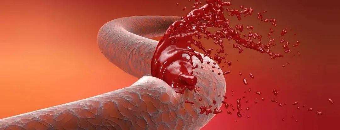 急性脑出血和脑血栓症状,急性脑出血康复锻炼视频