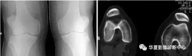 膝关节痛警惕四种病,科普膝关节疼痛影响到的22种疾病