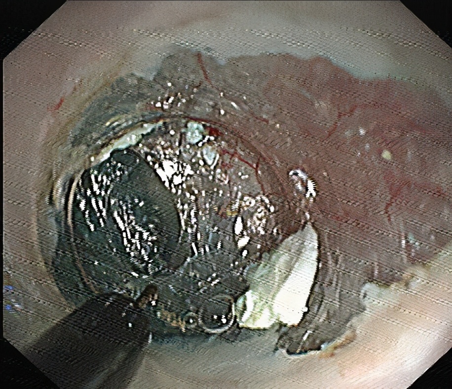 内镜下贲门失弛缓症微创手术,贲门失弛缓内镜治疗